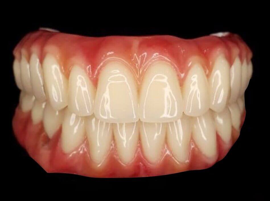 Odontologia Michelin oferece serviço de Implantes Dentais